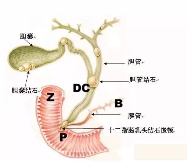 林平医案医话(十一):中医治疗显奇效,和『胆囊结石』彻底说"拜拜"!