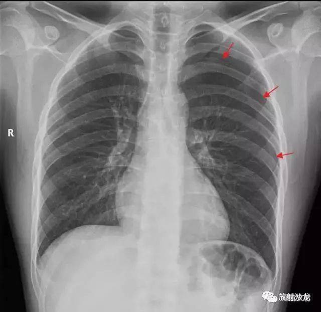 x线诊断要点丨气胸,胸膜及胸壁病变