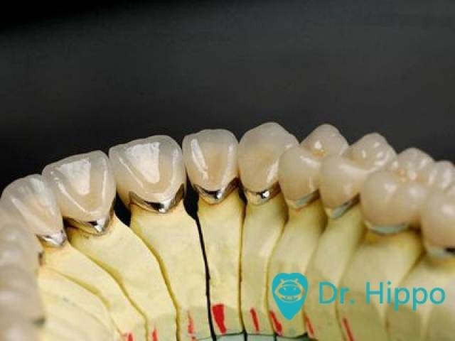 牙齿修复材料怎么选?#河马医生有绝招#