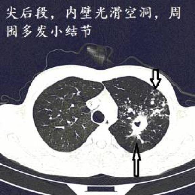 【实战演练】十二个病人的肺ct图像详细解读!-健康