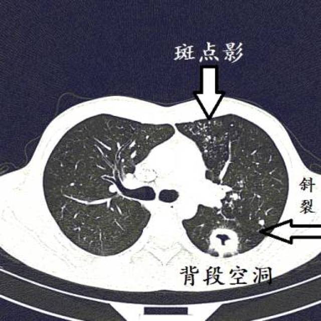 【实战演练】十二个病人的肺ct图像详细解读!