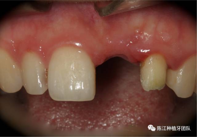 【病例分享】游离结缔组织移植在美学区种植中的应用一例