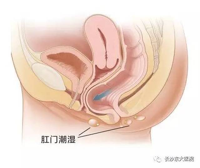 三分钟告诉你 肛门潮湿是怎么回事