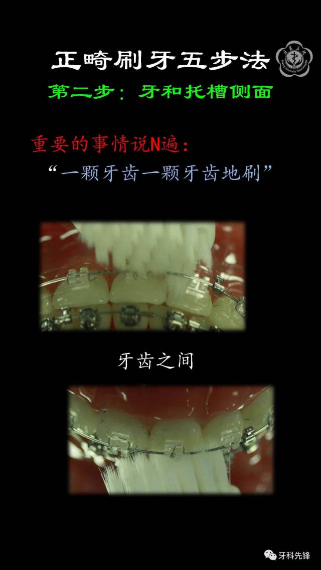 【视频】正畸时如何刷牙?用牙线?牙间刷?