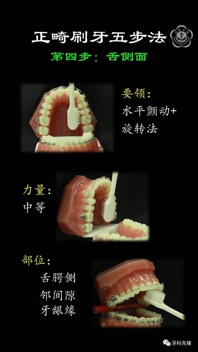 【视频】正畸时如何刷牙?用牙线?牙间刷?