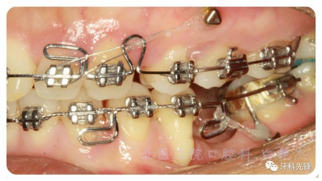 【视频】正畸时如何刷牙?用牙线?牙间刷?