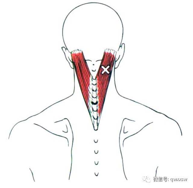 激痛点疗法——头夹肌