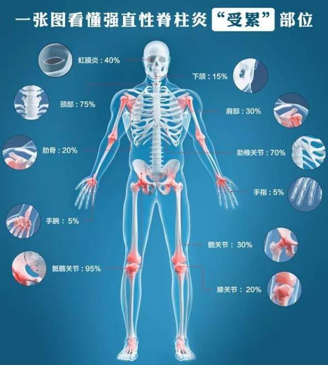 专业分享 | 如此折磨周杰伦的「强直性脊柱炎」,到底是个什么病?