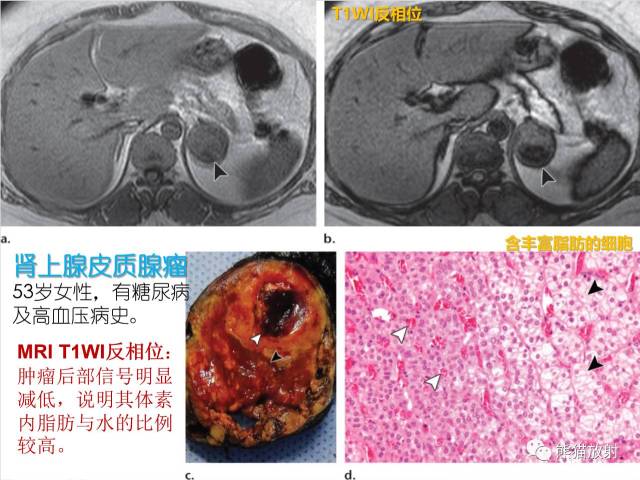 一图秒懂丨非医源性皮质醇增多症之各类肾上腺病变的表现