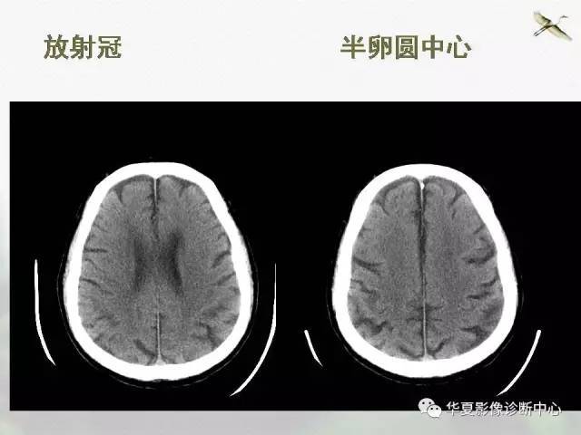 《影像基础》—半卵圆中心与放射冠有什么区别