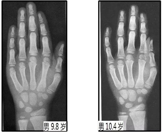 2骨龄年龄(ba) 代表发育年龄,根据x线的特定图像确定,观察左手掌指骨