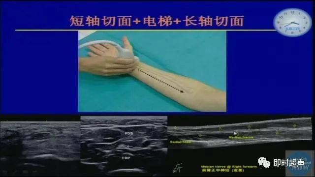 专家课堂01崔立刚上肢神经的超声识别技巧常见病变