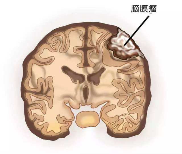 脑膜瘤是常见的在颅脑肿瘤,发病率仅次于胶质瘤,约占20-30%.