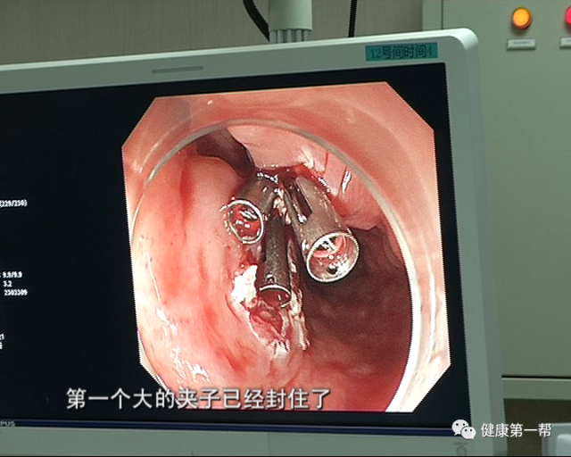 直击手术室:内镜下憩室切除手术