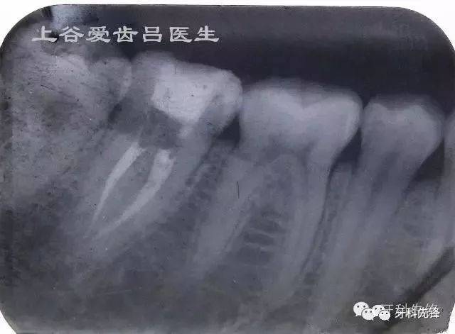 根管治疗后的牙齿一定要做牙冠吗?