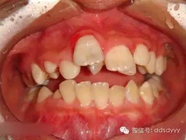 越早看医生越好12岁前应该处理的20种儿童牙颌畸形