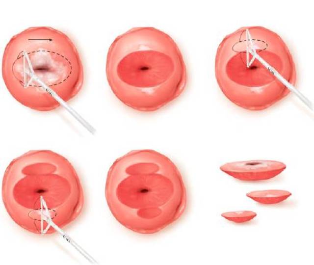 使用环形电极丝传导高频交流电分离和切除宫颈组织的一种宫颈锥切手术