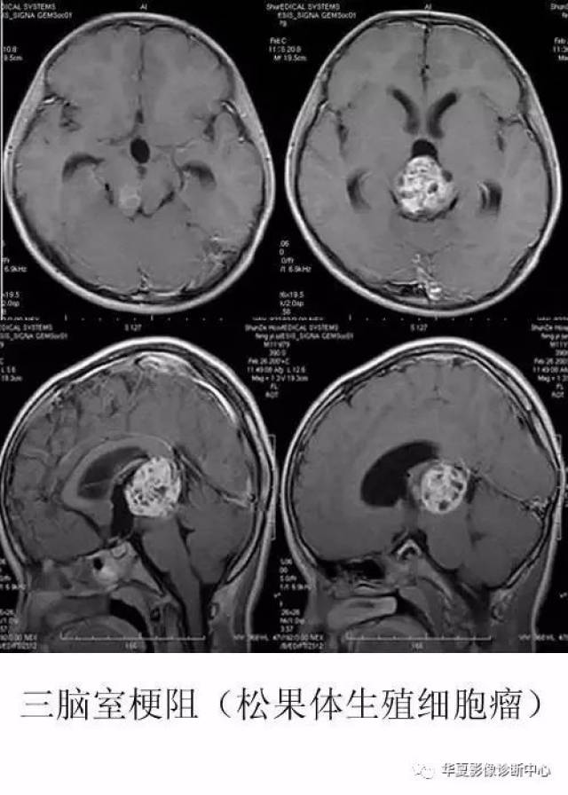 最常见为丘脑及基底节区血肿,丘脑区,松果体区肿瘤,ct表现为三脑室