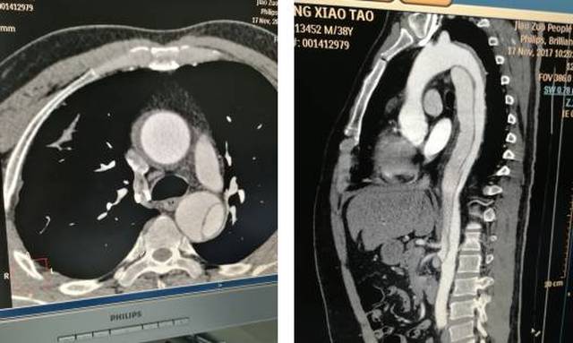 多科齐心顺利完成特殊重症主动脉夹层动脉瘤手术1例