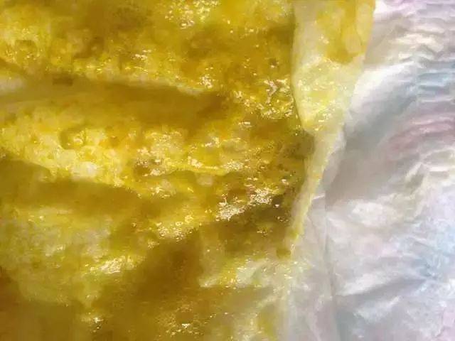 10  豆腐渣样的大便 如果宝宝的便便是黄绿色带着黏液,呈豆腐渣样