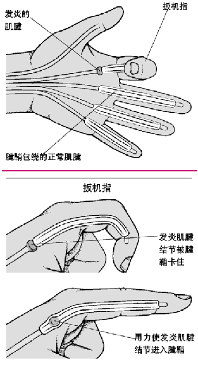 "扳机指"——大拇指腱鞘炎!