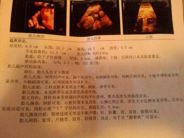 四维彩超的这些细节,其实已经透露了胎儿性别!