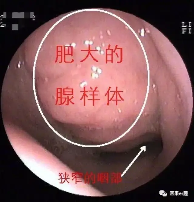 新入科的规培生开始问我了:"腺样体肥大只能手术治疗吗?" 肯定不是!