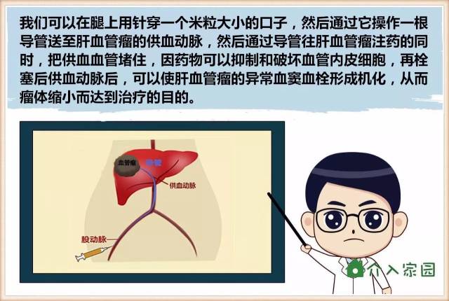 漫画科普│体检发现肝血管瘤,怎么办?