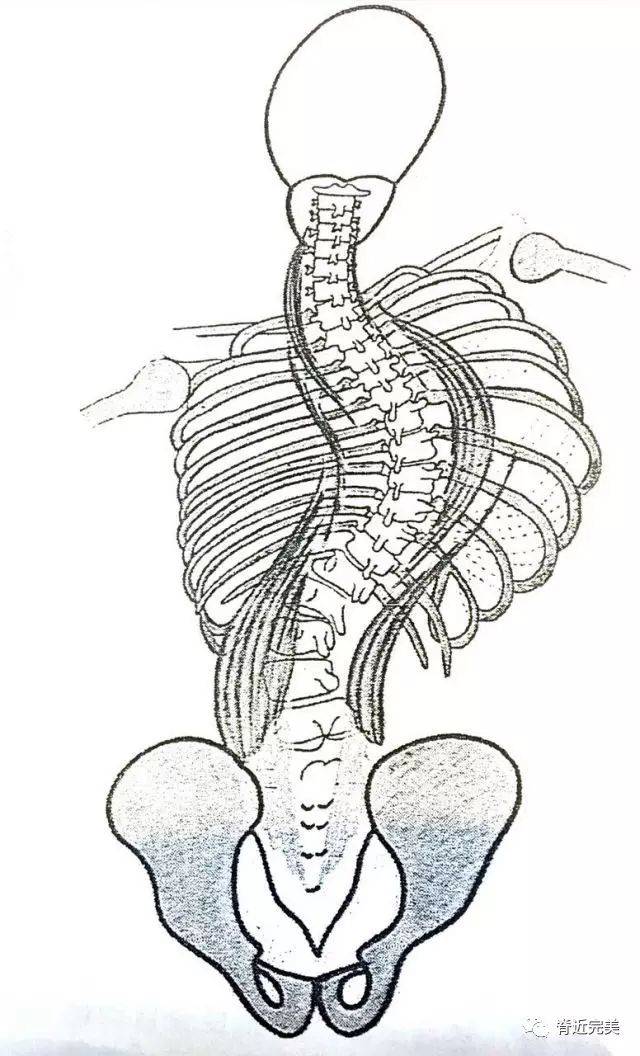 肌肉失衡分析得出:脊柱侧弯并非无药可救