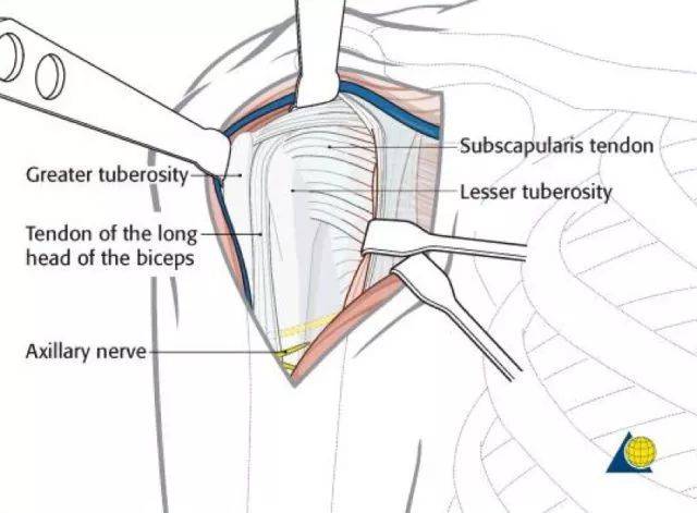 图 3 显露肱骨近端解剖结构 02
