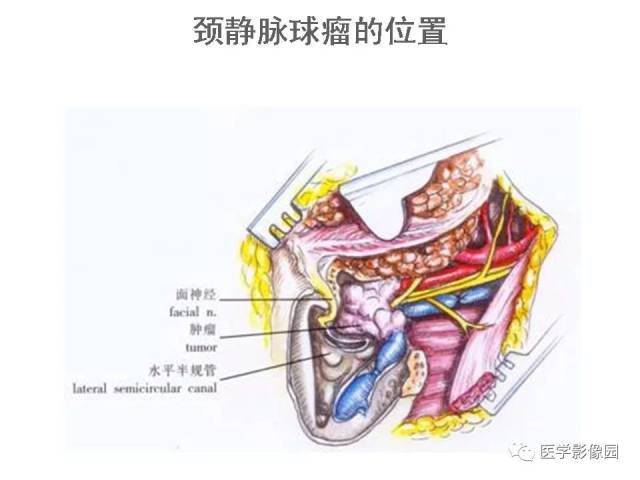 颈静脉球瘤影像表现丨影像天地