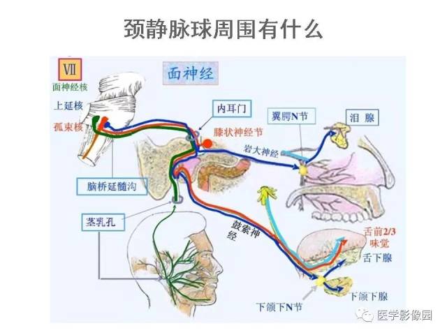 颈静脉球瘤影像表现丨影像天地