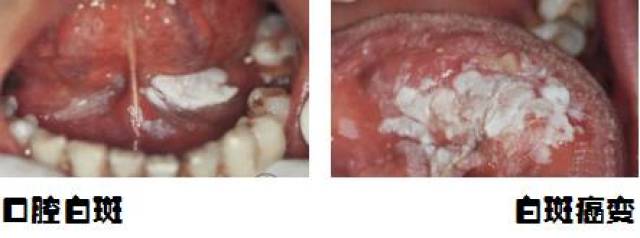 发生在口腔黏膜上的溃疡,斑块,增生等,常见的有白斑,纤维化病变,口