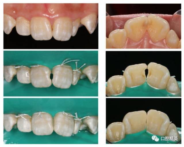 前牙美学树脂充填病例分享