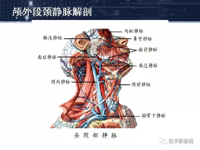 颈静脉球瘤影像表现丨影像天地