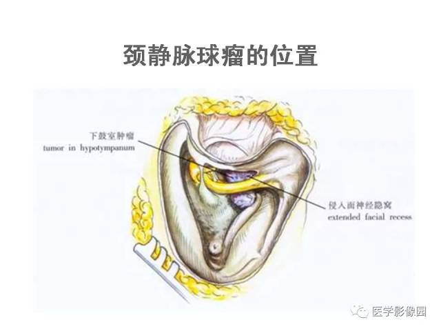 颈静脉球瘤影像表现丨影像天地