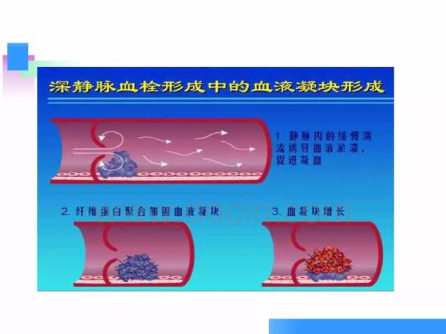 下肢静脉血栓滤网术后护理