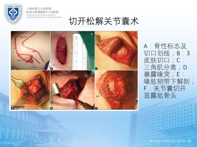 今晚8点直播|大师级手术专家程飚:带你掌握肩关节镜技术应用