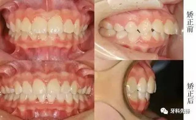 【病例】牙齿矫正案例:"龅牙妹"的蜕变之路