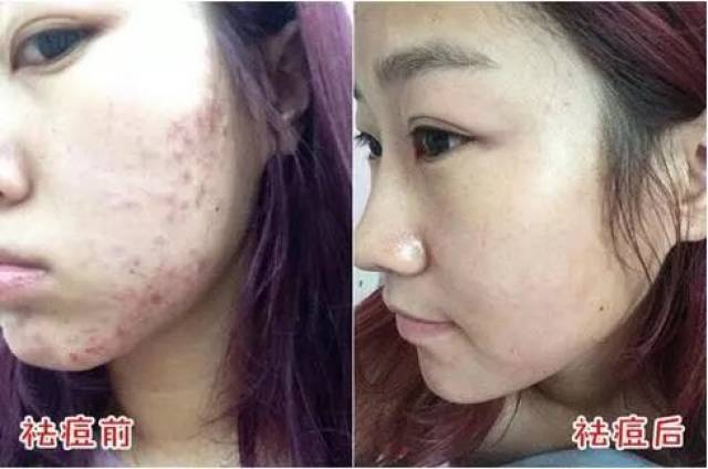 泉州一女子挤痘痘后,脸上竟然出现.