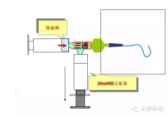 导管溶栓负压再通技术