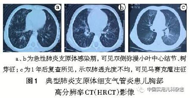 肺炎支原体细支气管炎