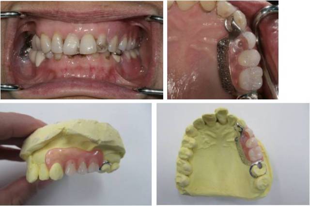 (病例1)患者上颌24,25,26缺失, 牙合间距离小,尖牙不希望暴露金属卡