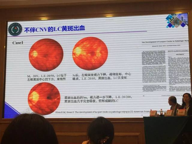 西南医科大学附属医院吕红彬教授病理性近视引起的8种眼底改变