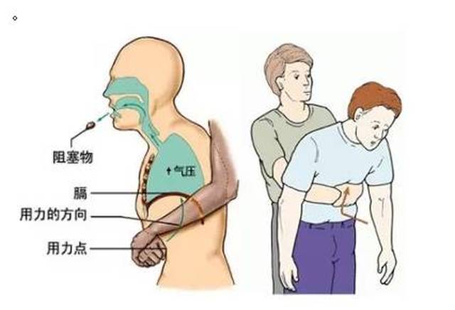 如何预防异物吸入