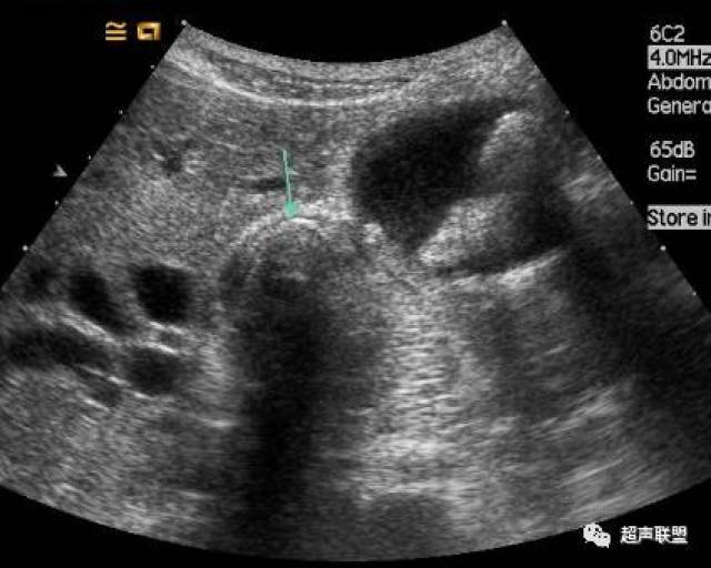 胆囊结石超声诊断,典型非典型声像图,统统告诉你.