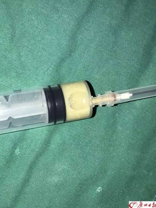 面部也有“危险三角区”！别再随便挤痘痘啦，