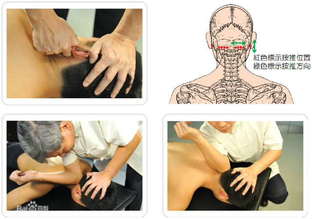 肌筋膜治疗及《原始点医学》手法图例,值得你收藏!