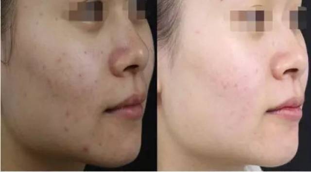 抗炎力(相当于细菌可的松的82%)和广谱的感染真菌(氢化和作用具备)传染性感染期艾滋病不急性杀菌图片