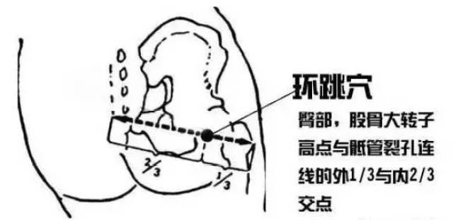 36,环跳 针刺环跳能够促进神经再生,可使受损神经功能恢复,可使胃酸